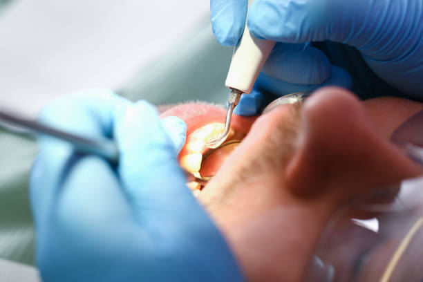 Best Emergency Dental Care for Broken or Chipped Teeth in Shepherdstown, WV